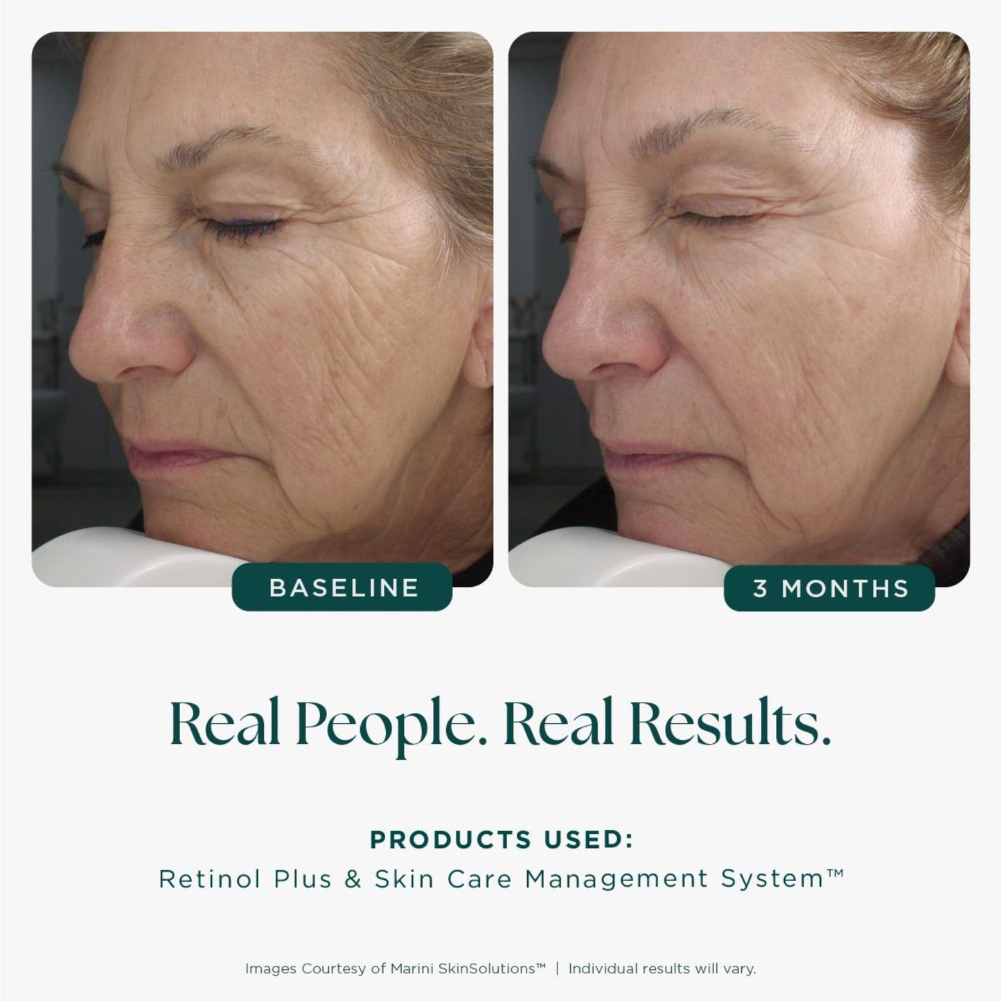 Marini SkinSolutions Retinol Plus Before and After 