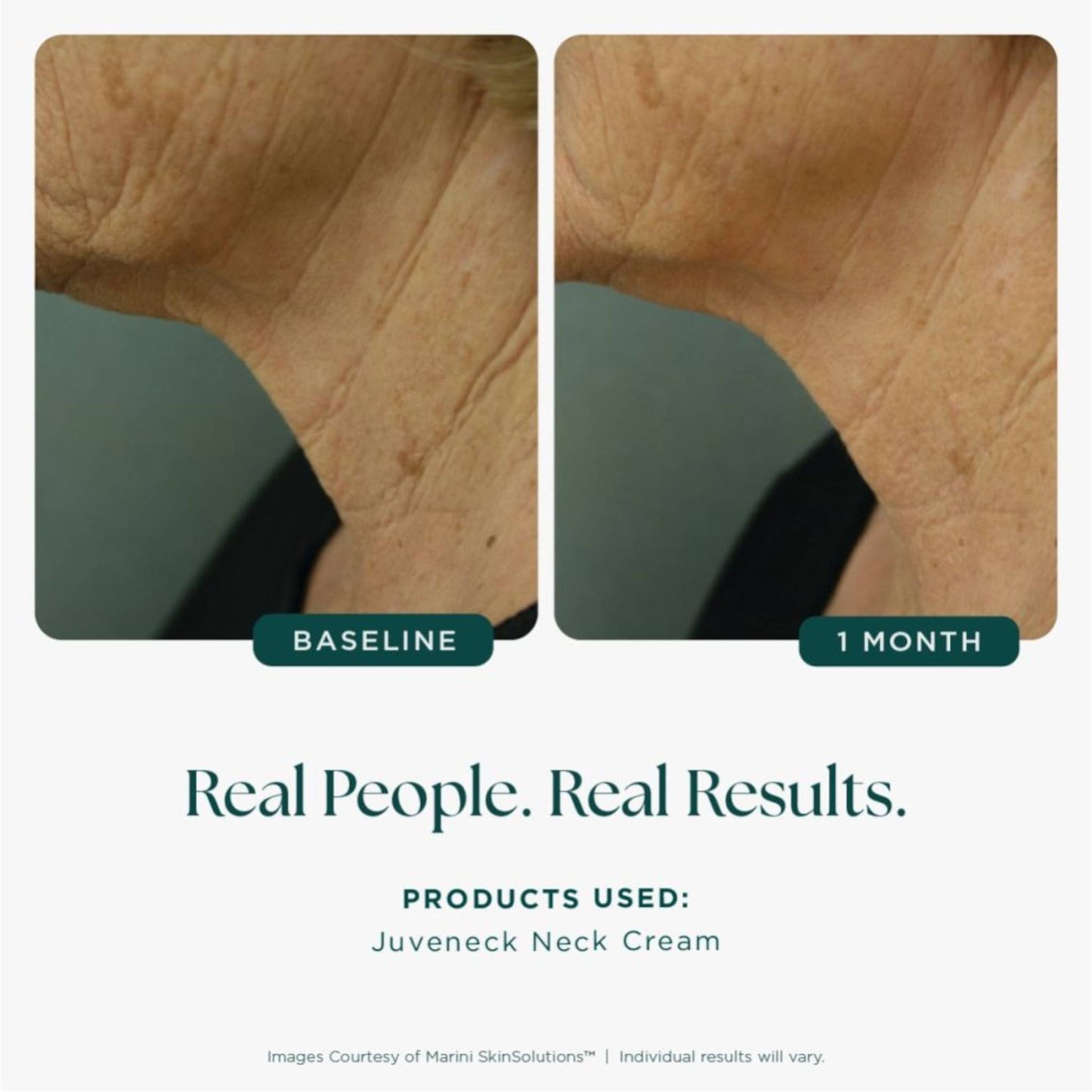 Before and after comparison of neck skin texture with Juveneck Neck Cream, showing visible improvement.